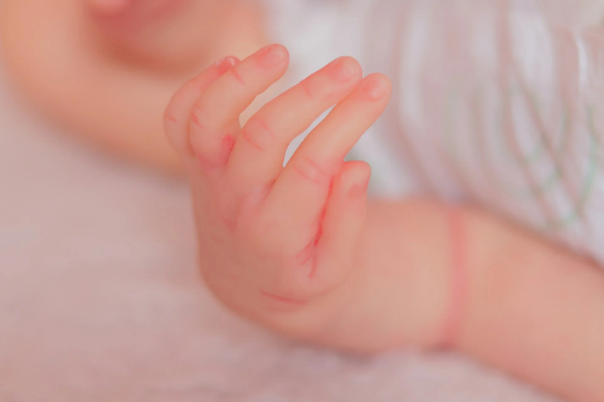 psoriasis bebe